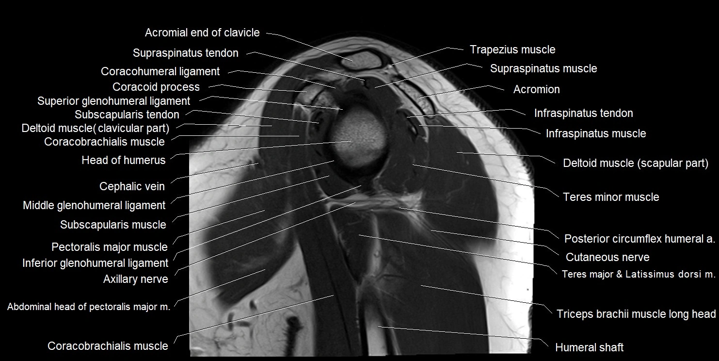 mri shoulder sagittal cross sectional anatomy image 8.webp